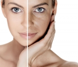 Acido etidr�nico: su aplicaci�n en alteraciones pigmentarias