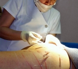 Est�tica sin cirug�a: lifting de gl�teos con hilos